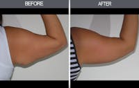 Arm Lift (Brachioplasty) Gallery Before & After Gallery - Patient 4453262 - Image 1