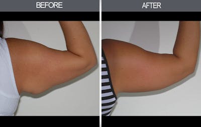 Arm Lift (Brachioplasty) Before & After Gallery - Patient 4453262 - Image 1