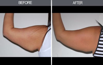 Arm Lift (Brachioplasty) Gallery Before & After Gallery - Patient 4453262 - Image 2