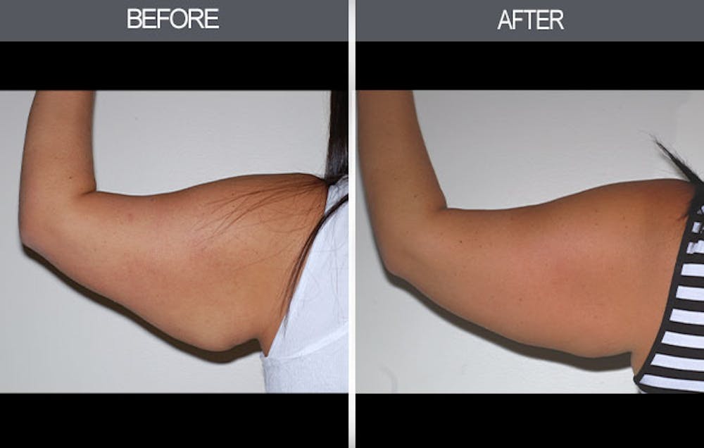 Arm Lift (Brachioplasty) Before & After Gallery - Patient 4453262 - Image 2