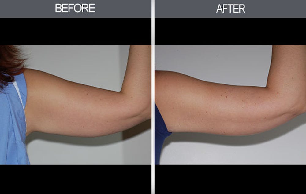 Arm Lift (Brachioplasty) Gallery Before & After Gallery - Patient 4453263 - Image 1