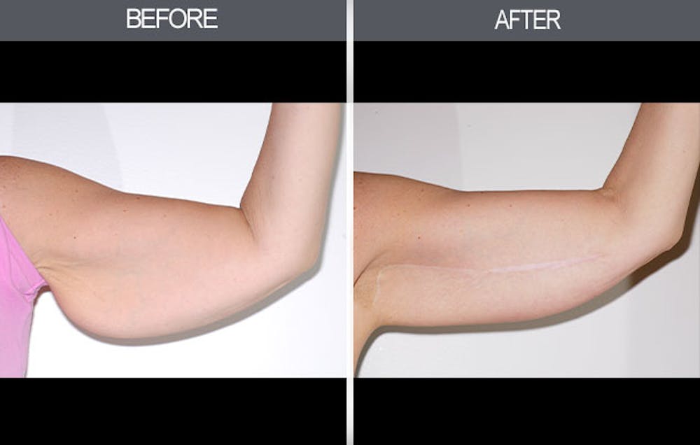 Arm Lift (Brachioplasty) Gallery Before & After Gallery - Patient 4453264 - Image 1