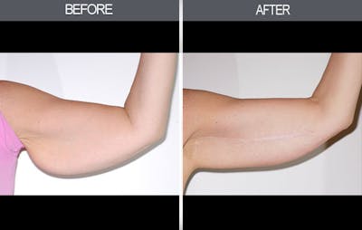 Arm Lift (Brachioplasty) Before & After Gallery - Patient 4453264 - Image 1