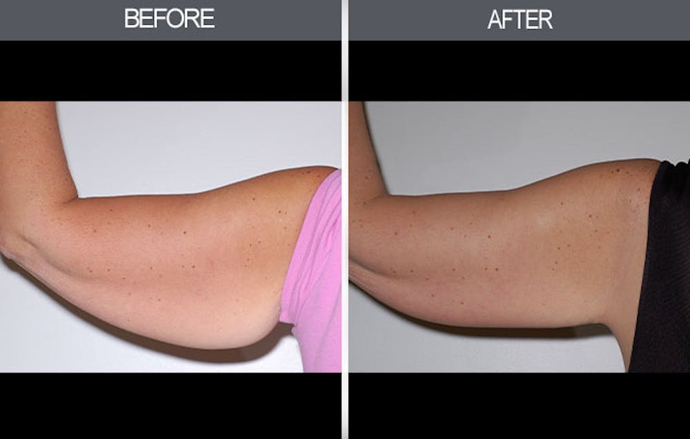 Arm Lift (Brachioplasty) Gallery Before & After Gallery - Patient 4453264 - Image 2