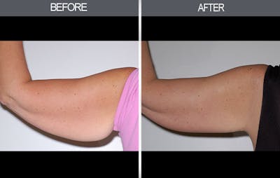 Arm Lift Before & After Gallery - Patient 4453264 - Image 2
