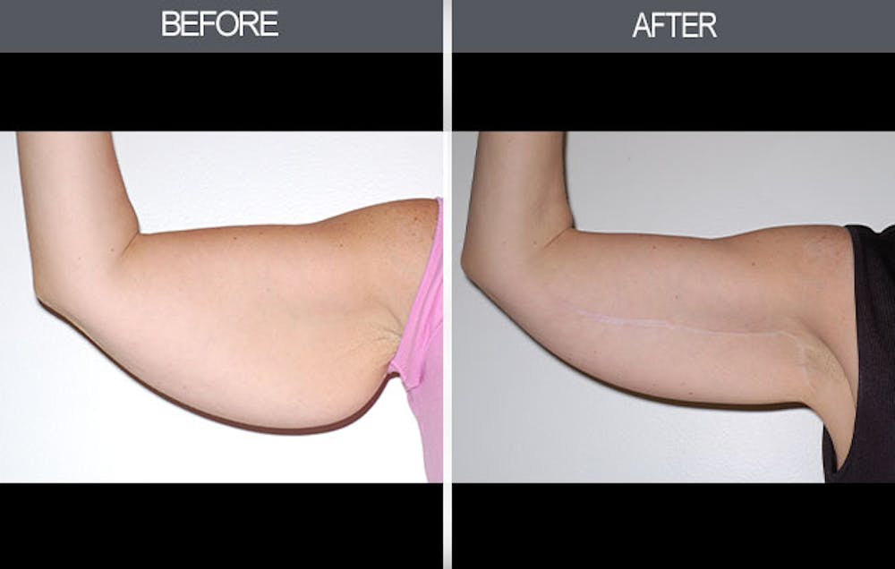 Arm Lift (Brachioplasty) Before & After Gallery - Patient 4453264 - Image 3