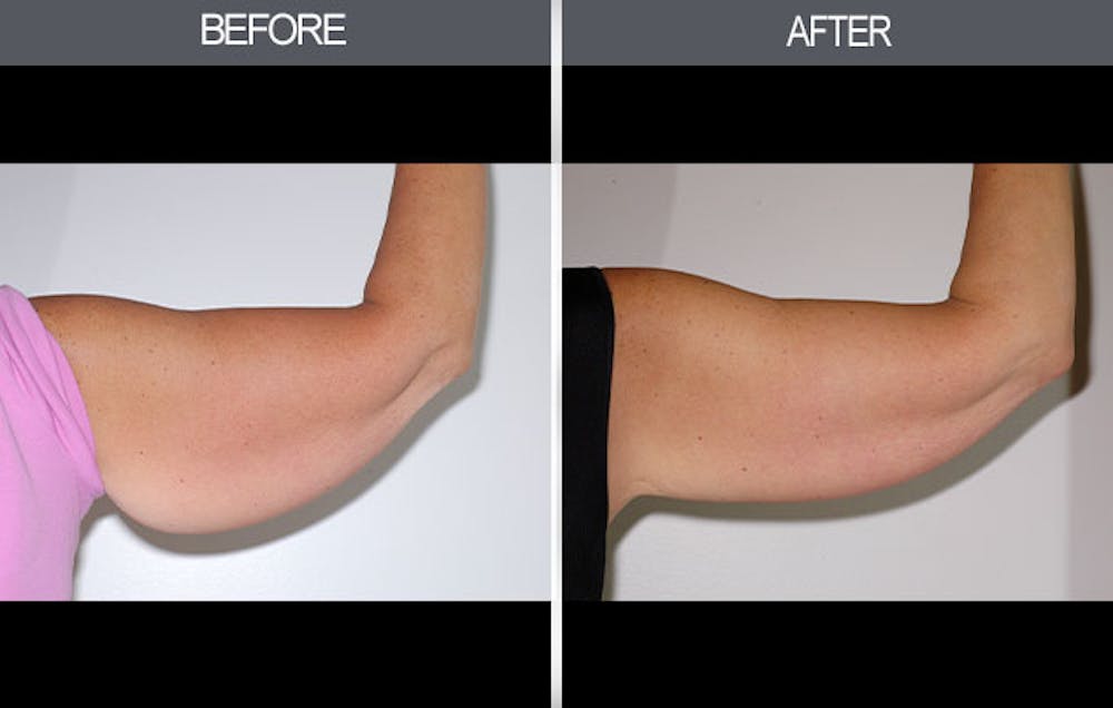 Arm Lift (Brachioplasty) Gallery Before & After Gallery - Patient 4453264 - Image 4