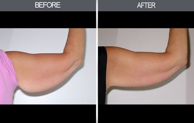 Arm Lift (Brachioplasty) Gallery Before & After Gallery - Patient 4453264 - Image 4