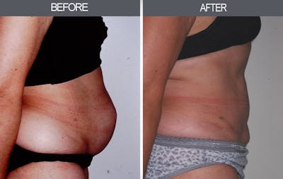 Tummy Tuck Gallery Before & After Gallery - Patient 4453576 - Image 1
