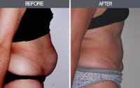 Tummy Tuck Gallery Before & After Gallery - Patient 4453576 - Image 1
