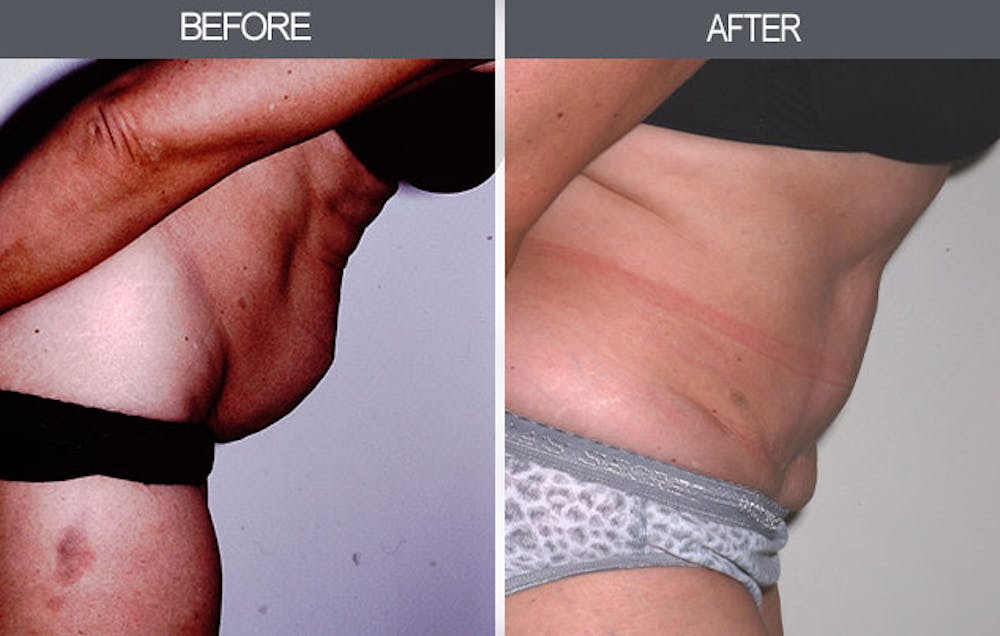 Tummy Tuck Before & After Gallery - Patient 4453576 - Image 2