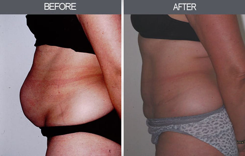 Tummy Tuck Gallery Before & After Gallery - Patient 4453576 - Image 3