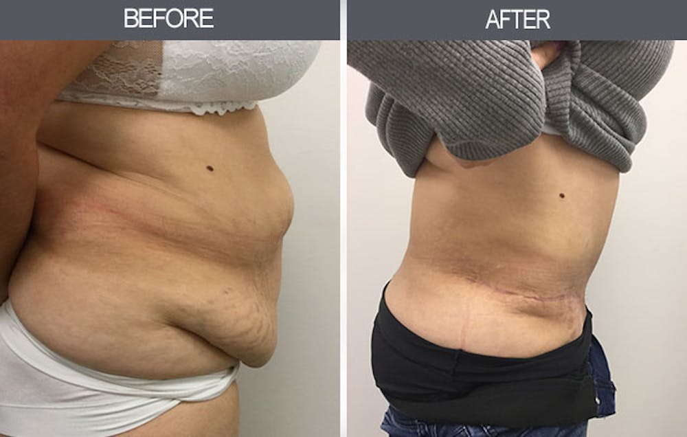 Tummy Tuck Gallery Before & After Gallery - Patient 4453577 - Image 1