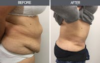 Tummy Tuck Gallery Before & After Gallery - Patient 4453577 - Image 1