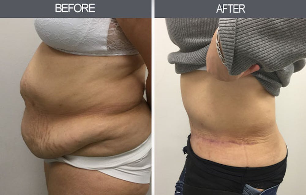 Tummy Tuck Before & After Gallery - Patient 4453577 - Image 2