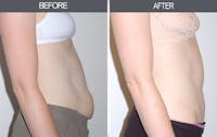 Tummy Tuck Before & After Gallery - Patient 4453578 - Image 1