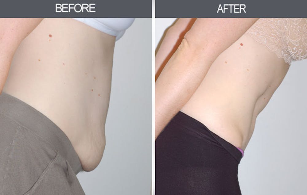 Tummy Tuck Gallery Before & After Gallery - Patient 4453578 - Image 2