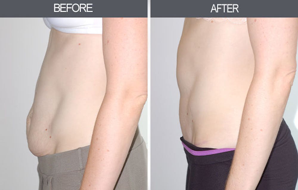 Tummy Tuck Gallery Before & After Gallery - Patient 4453578 - Image 3