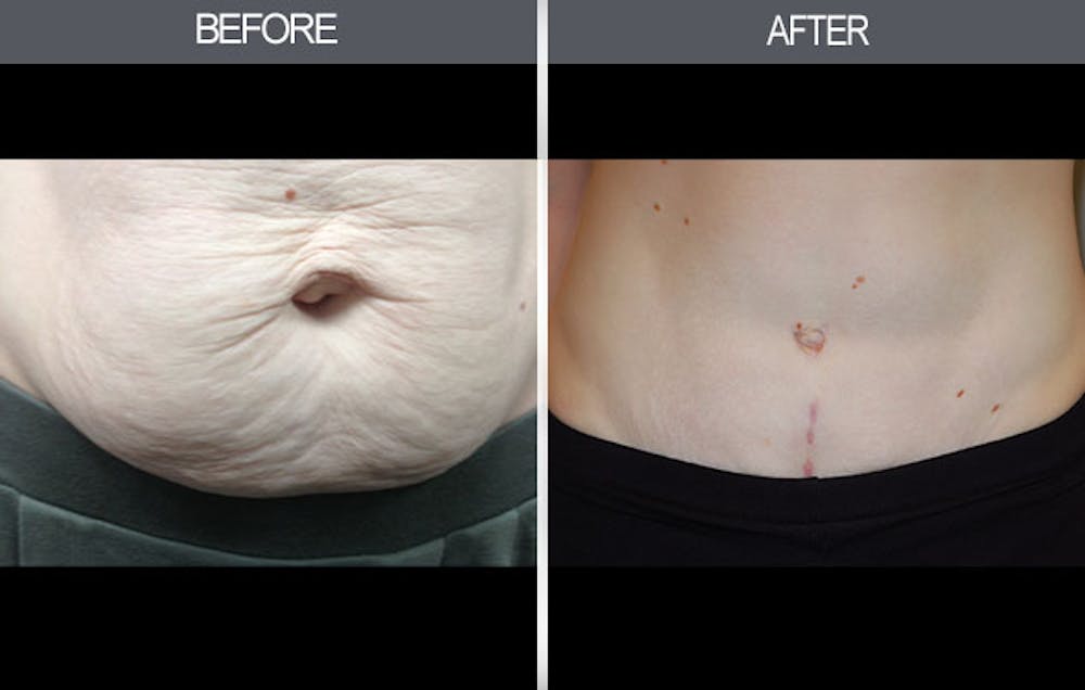 Tummy Tuck Gallery Before & After Gallery - Patient 4453578 - Image 4