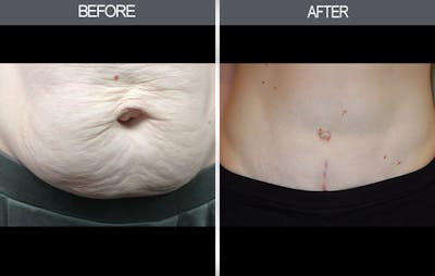 Tummy Tuck Gallery Before & After Gallery - Patient 4453578 - Image 4