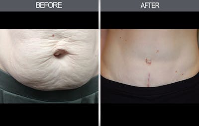 Tummy Tuck Before & After Gallery - Patient 4453578 - Image 4