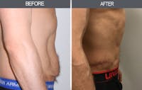 Tummy Tuck Gallery Before & After Gallery - Patient 4453579 - Image 1