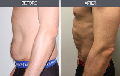 Tummy Tuck Gallery Before & After Gallery - Patient 4453579 - Image 2