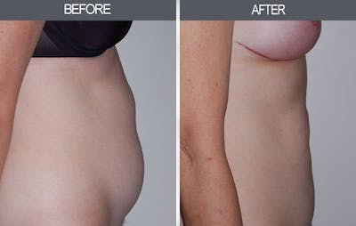 Tummy Tuck Gallery Before & After Gallery - Patient 4453580 - Image 1