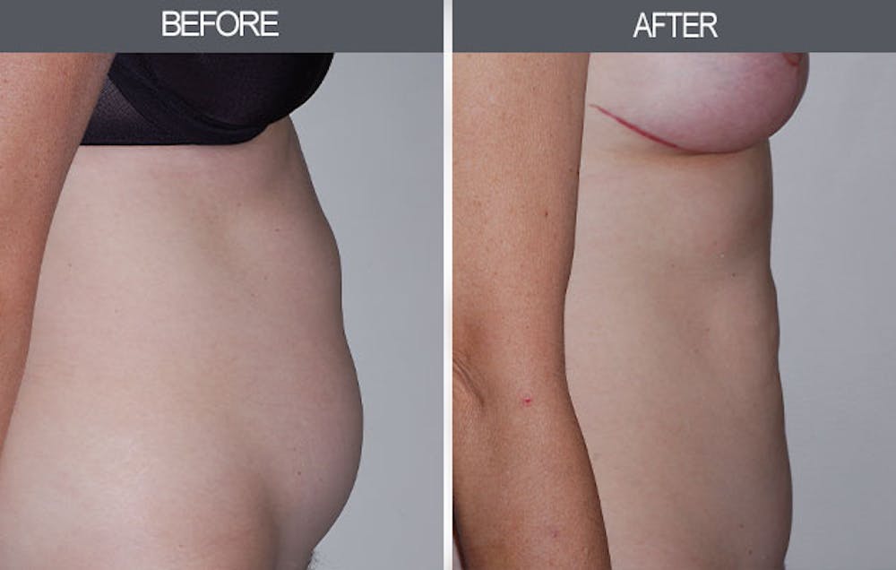 Tummy Tuck Before & After Gallery - Patient 4453580 - Image 1