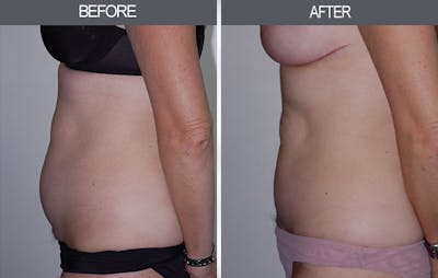 Tummy Tuck Gallery Before & After Gallery - Patient 4453580 - Image 2
