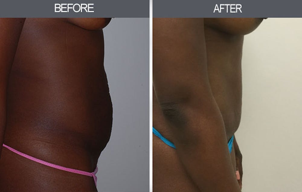 Tummy Tuck Gallery Before & After Gallery - Patient 4453581 - Image 1