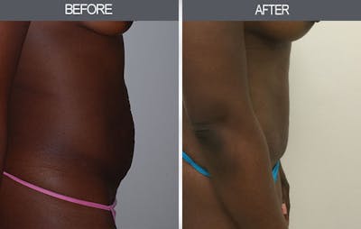 Tummy Tuck Gallery Before & After Gallery - Patient 4453581 - Image 1