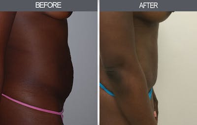 Tummy Tuck Before & After Gallery - Patient 4453581 - Image 1
