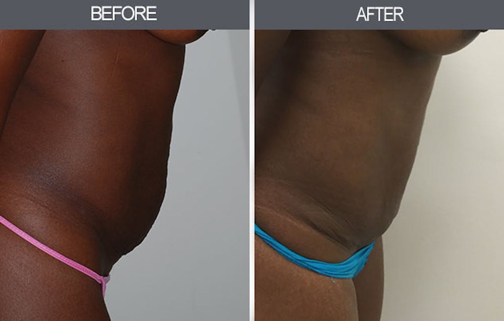 Tummy Tuck Gallery Before & After Gallery - Patient 4453581 - Image 2