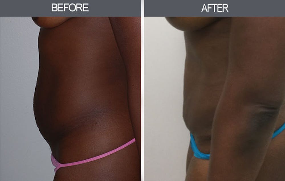 Tummy Tuck Gallery Before & After Gallery - Patient 4453581 - Image 3
