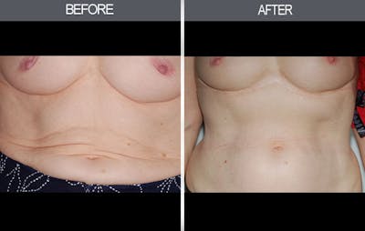 Tummy Tuck Gallery - Patient 4453582 - Image 1