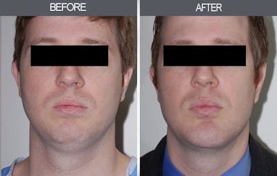 Submental Liposuction Gallery Before & After Gallery - Patient 4453813 - Image 1