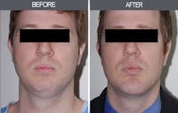 Submental Liposuction Before & After Gallery - Patient 4453813 - Image 1