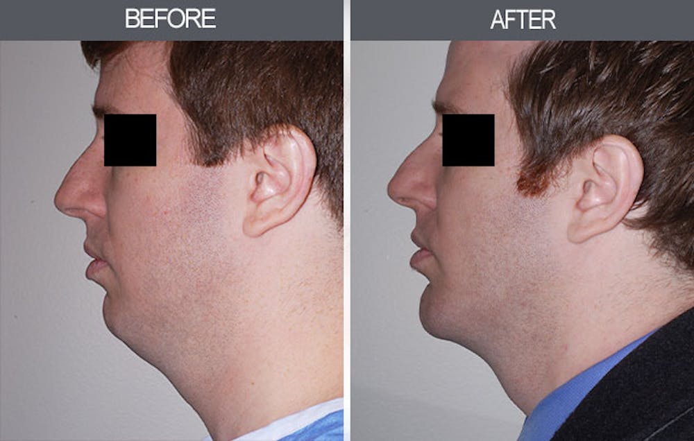 Submental Liposuction Gallery Before & After Gallery - Patient 4453813 - Image 2