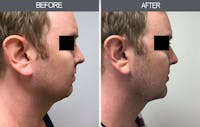 Submental Liposuction Gallery Before & After Gallery - Patient 4453814 - Image 1