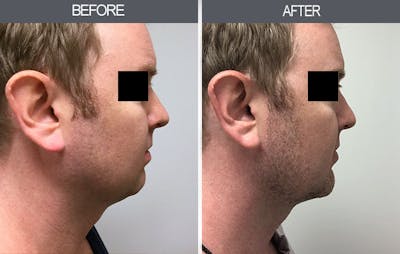 Submental Liposuction Before & After Gallery - Patient 4453814 - Image 1