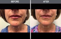 Mole Removal Gallery Before & After Gallery - Patient 4454437 - Image 1