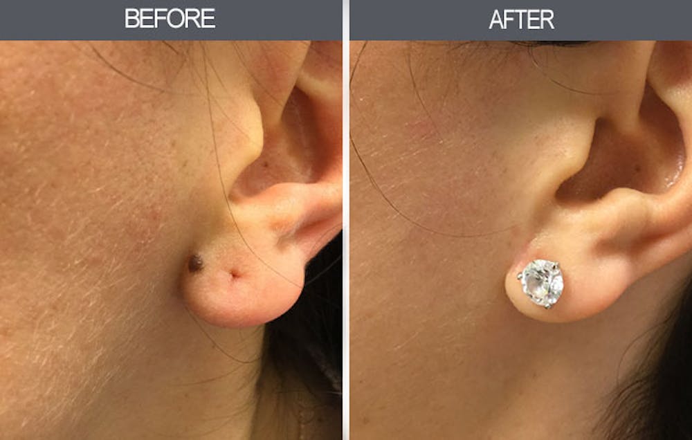 Mole Removal Gallery Before & After Gallery - Patient 4454438 - Image 2