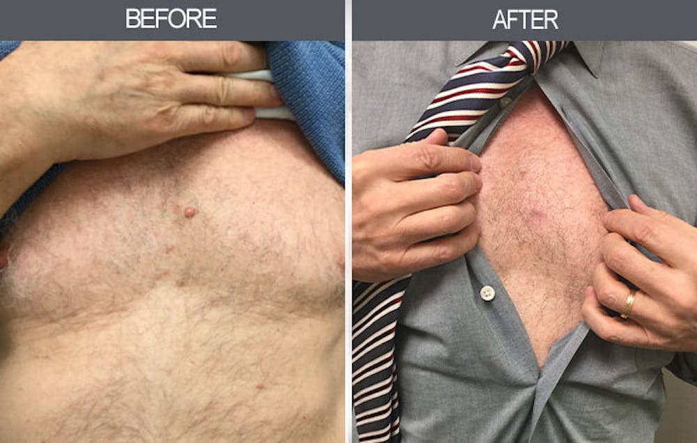 Mole Removal Gallery Before & After Gallery - Patient 4454439 - Image 1