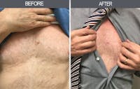 Mole Removal Before & After Gallery - Patient 4454439 - Image 1