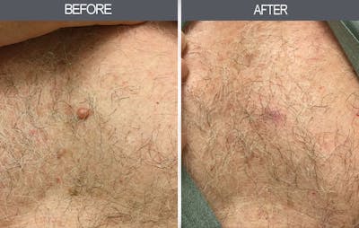 Mole Removal Gallery Before & After Gallery - Patient 4454439 - Image 2