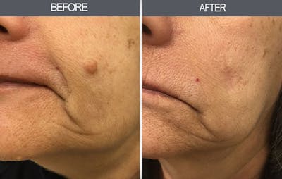 Mole Removal Before & After Gallery - Patient 4454442 - Image 1