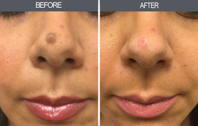 Mole Removal Before & After Gallery - Patient 4454443 - Image 1