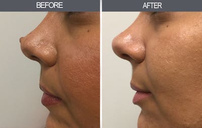 Mole Removal Gallery Before & After Gallery - Patient 4454443 - Image 2