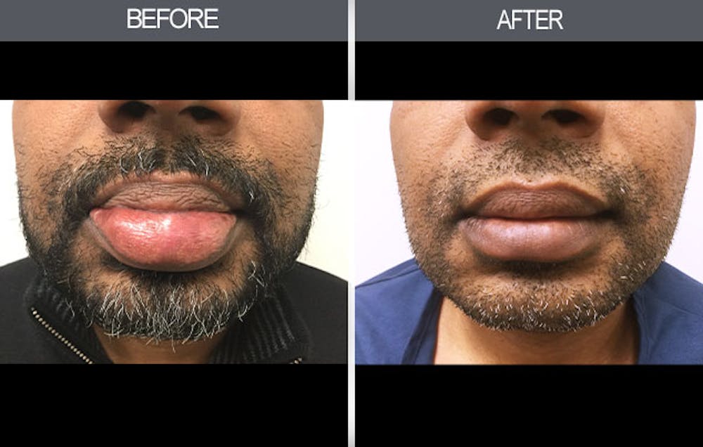 Lip Reduction Gallery Before & After Gallery - Patient 4455031 - Image 1